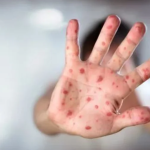 Una persona con sarampión ABC