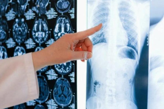 Una radiografía de tórax que muestra un cáncer de pulmón.