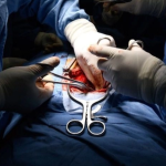 Periodico La Jornada /Trasplante de hígado, en imagen de archivo. Foto Cuartoscuro